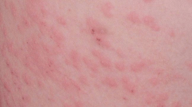 Что такое гистоплазмоз: причины, виды и возможные осложнения