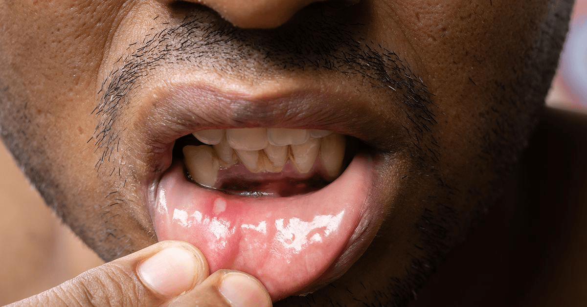 Og'izdagi Yaralar: Sabablari, Turlari, Belgilari va Davolash Usullari