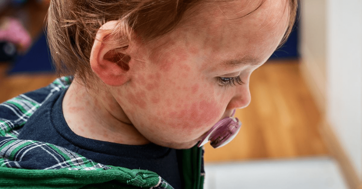 Как распознать пищевую аллергию у малыша и что делать при реакции