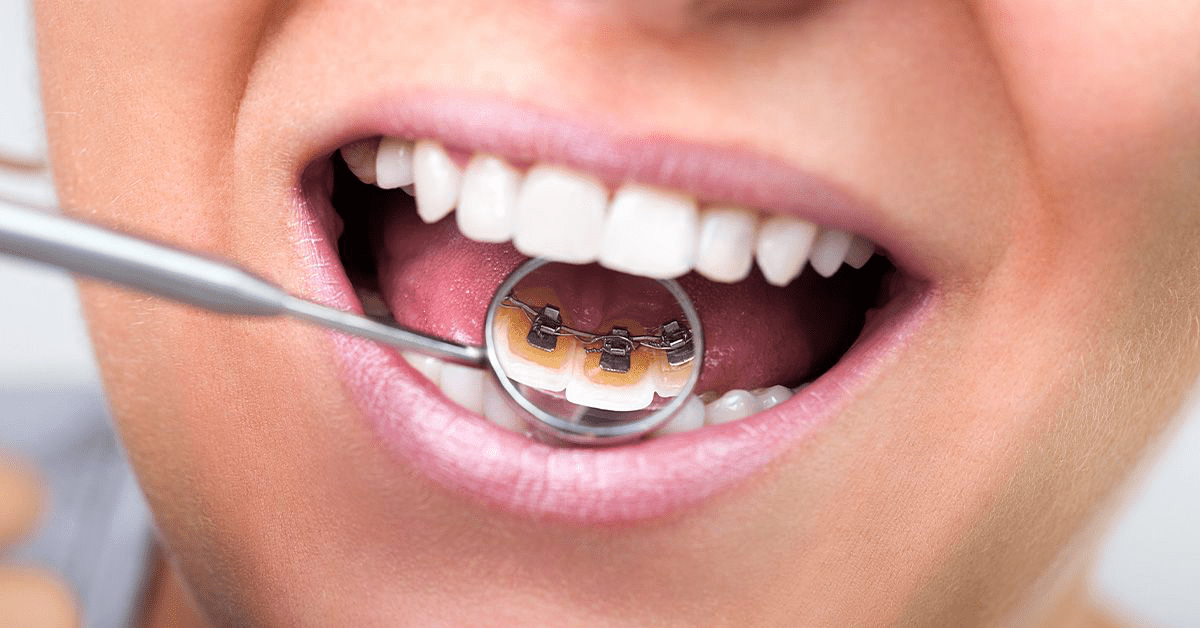 Lingual Braces 2025: Cost, Comfort, Lisping & Pros and Cons Explained