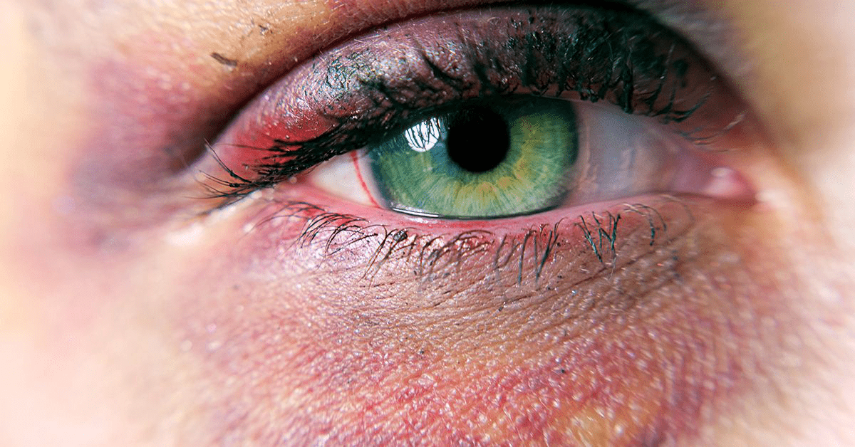 Effective Home Remedies for Black Eyes in 2025: Healing Time & Affordable Care Tips