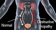 2025 Urinary Tract Obstruction Guide: Types, Causes & Symptoms Explained