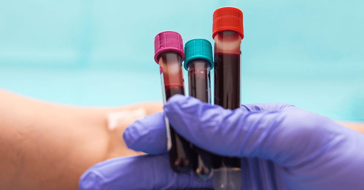 Factor VIII Assay Test 2025: Cost, Purpose & What Your Results Mean