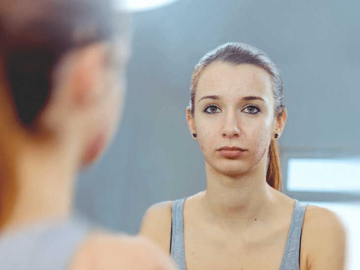 2025 Guide: How Stress Influences Acne and Effective Treatments Starting from $20