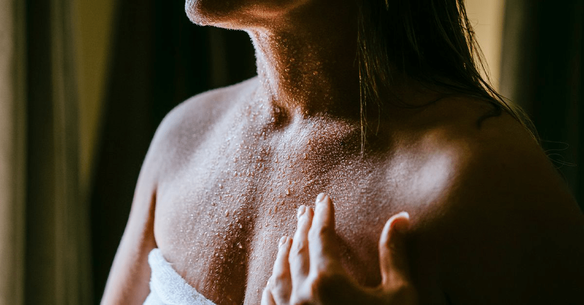 2025 Guide: Prickly Heat (Miliaria Rubra) - Causes, Symptoms & Affordable Treatments