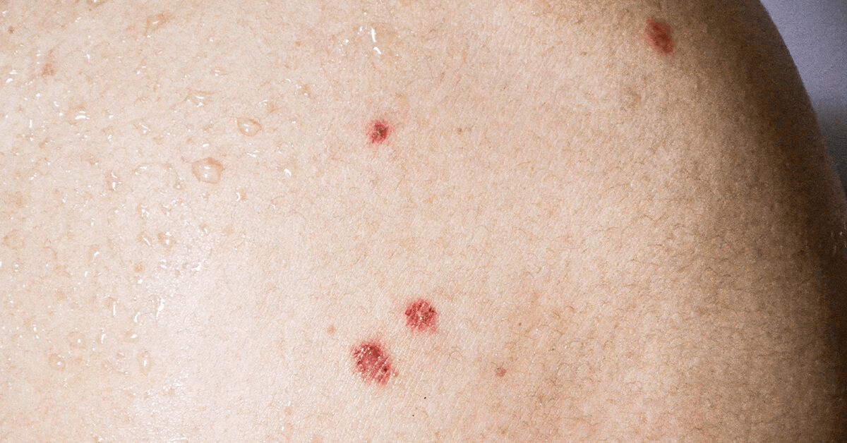 Teridagi Qizil Taranglar: Bowen Kasalligini Bilish va Davolash Usullari