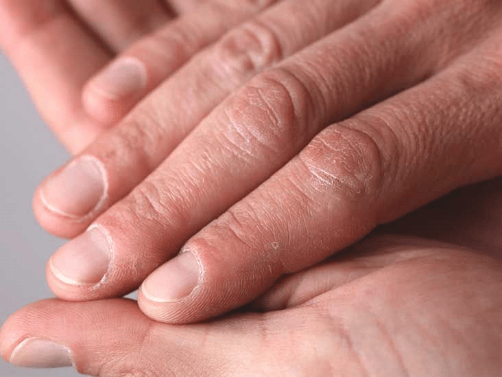 Что говорят бороздки на ногтях о вашем здоровье: причины и способы решения