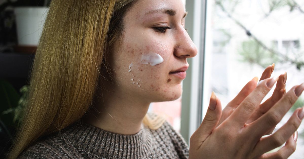 Гормональные ВМС и Акне: Что Нужно Знать Каждой Женщине