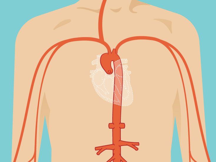 Аневризма восходящей аорты: современные методы диагностики и лечения