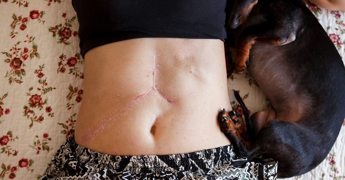 Jonli donor jigar ko‘chirish jarayonining afzalliklari va xavflari