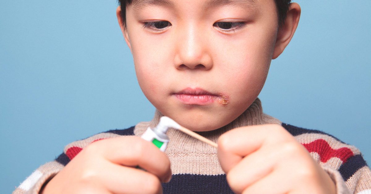 Эффективные способы борьбы с герпесом: роль лизина в лечении и предупреждении