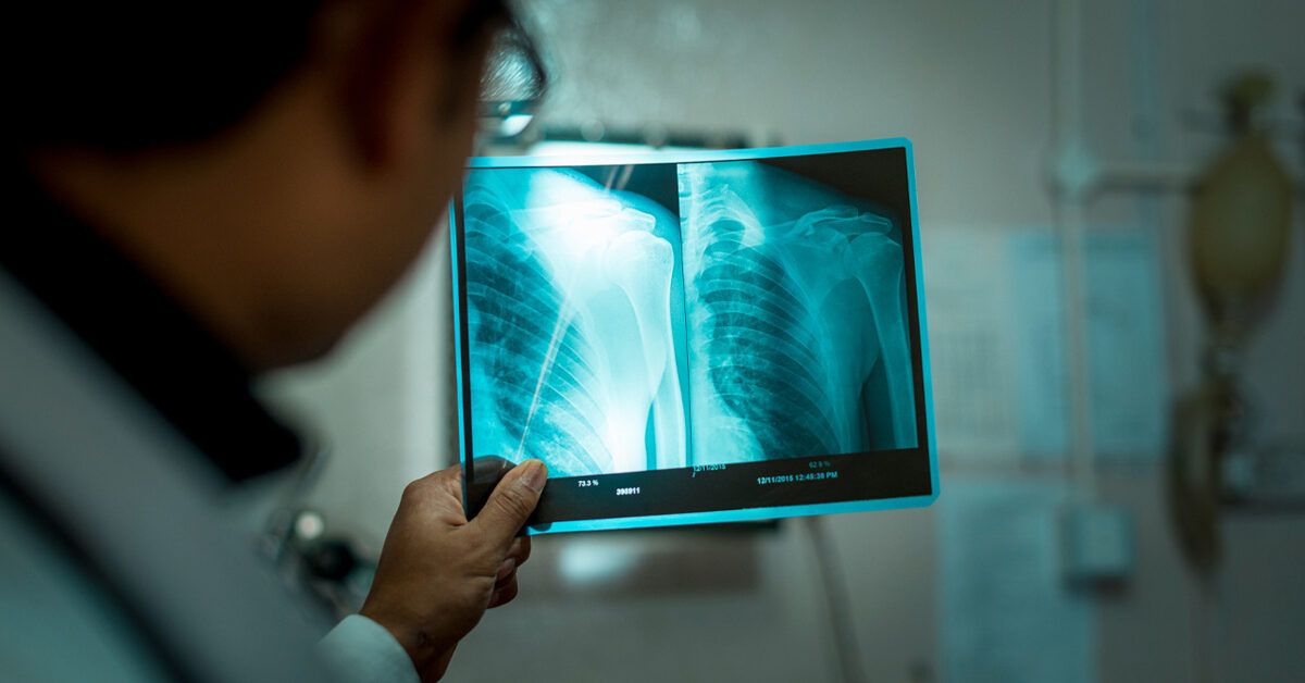 Primary Bone Lymphoma in 2025: Symptoms, Diagnosis, Treatment Options, and Cost Insights