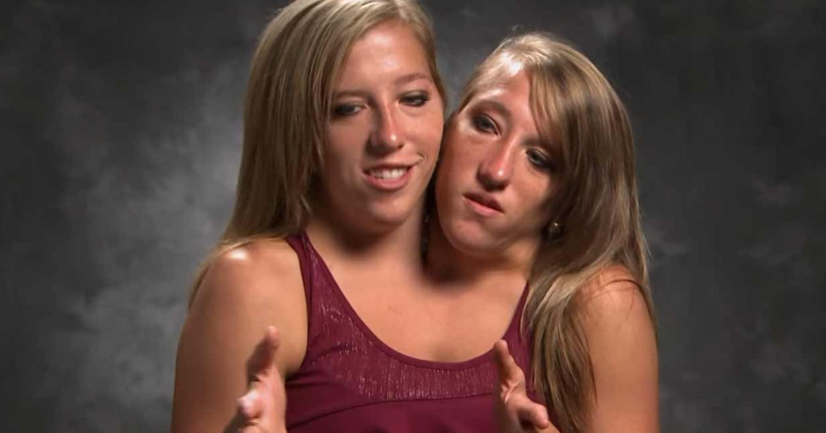 Siyam egizaklarning ajoyib hikoyalari: Bitta tanada yashashning qiyinchiliklari va muvaffaqiyatlari