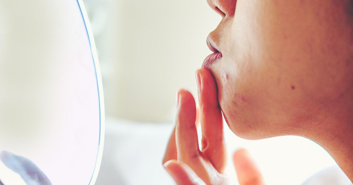 Эффективное решение для борьбы с кистозными высыпаниями: как кортизоновые инъекции помогают коже