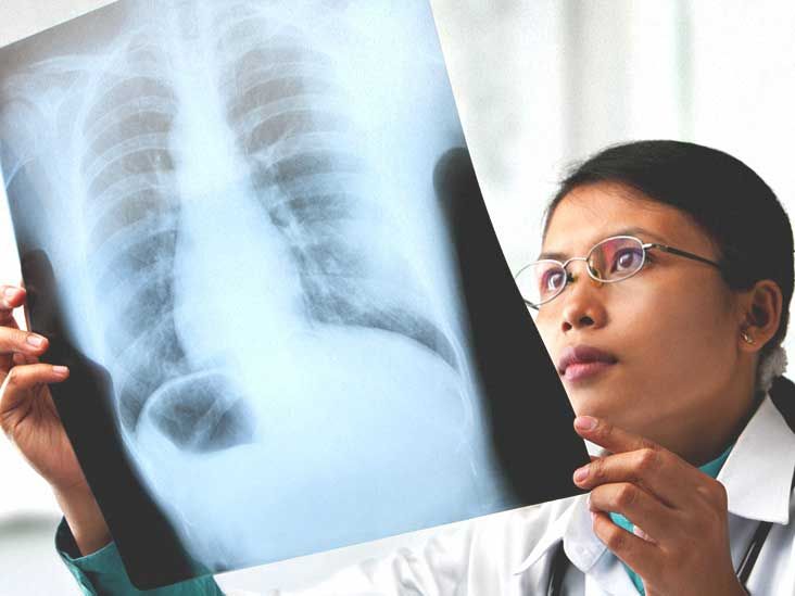 Understanding COPD Chest X-Rays: Key Insights and Visual Guide