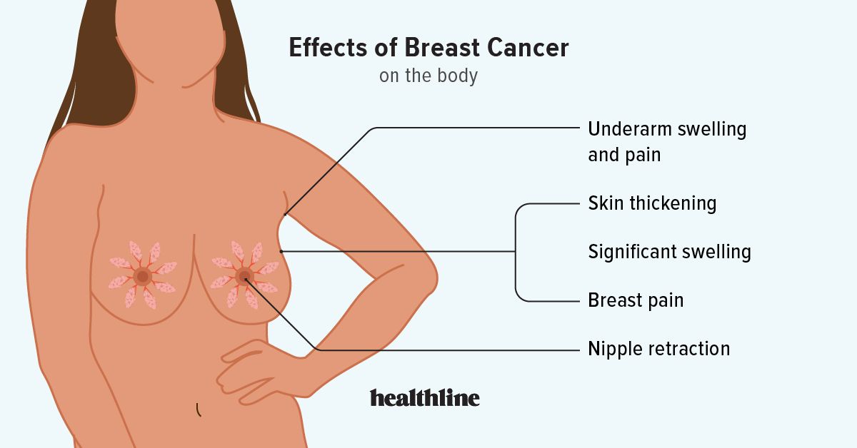 Ko'krak Saratoni Tana Qalbakiliklariga Ta'siri