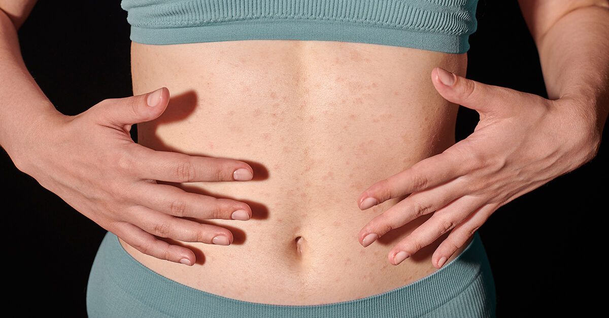 PCOS va Eczema: Terining Sog‘lig‘idagi Bog‘liqlik Sirlarini O‘rganamiz