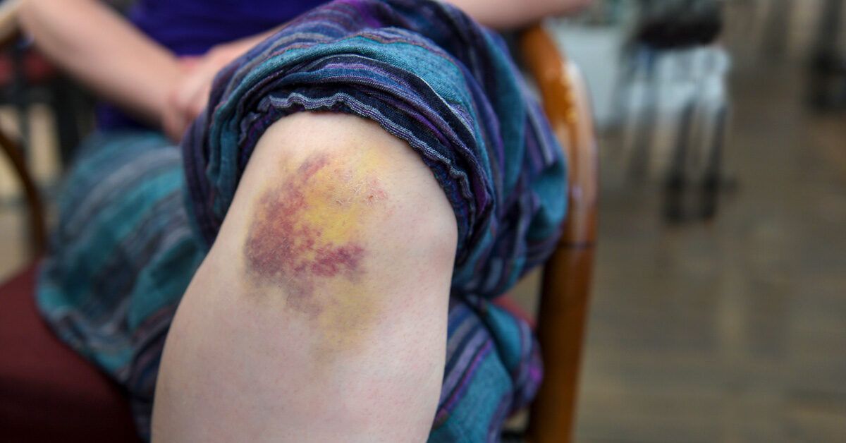 Неожиданные синяки: почему они появляются и как с этим бороться