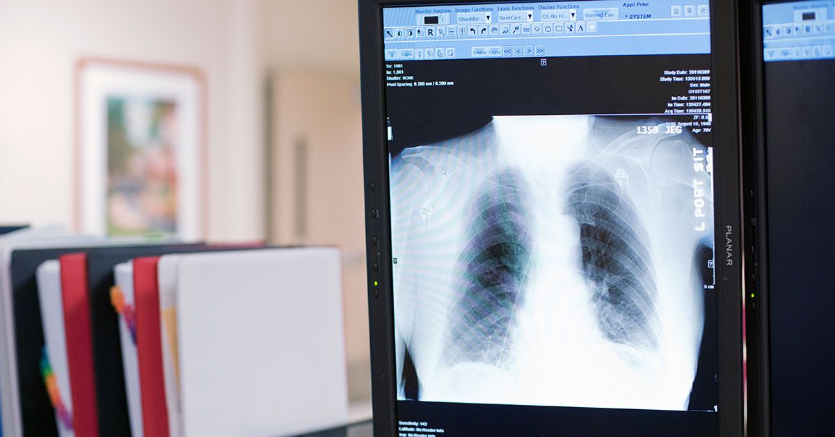 Understanding Squamous Cell Lung Carcinoma: Causes, Symptoms, and Treatments