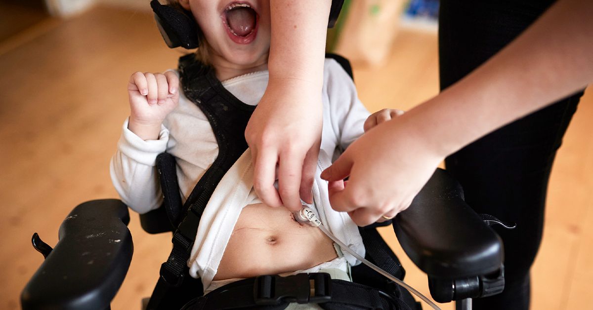 Intestinal Pseudo-Obstruction Explained: Key Symptoms, Diagnosis & Modern Treatments