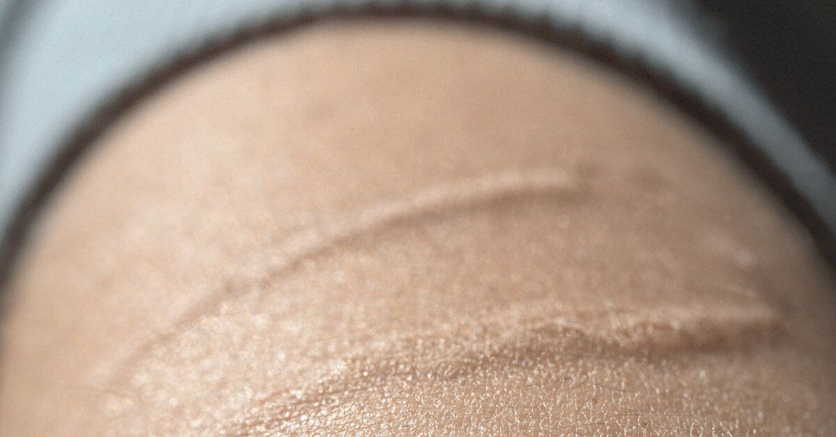 Top 10 Natural Remedies to Fade Old Scars in 2025 – Affordable and Effective Solutions