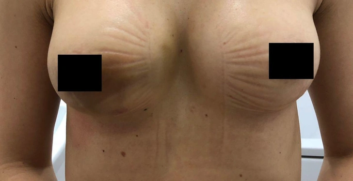 Состояние груди после первой операции