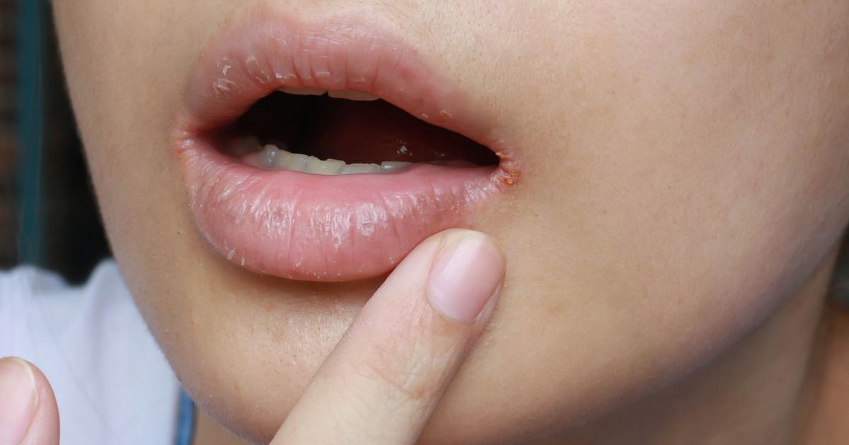 How to Heal and Prevent Painful Cracks at the Corners of Your Mouth