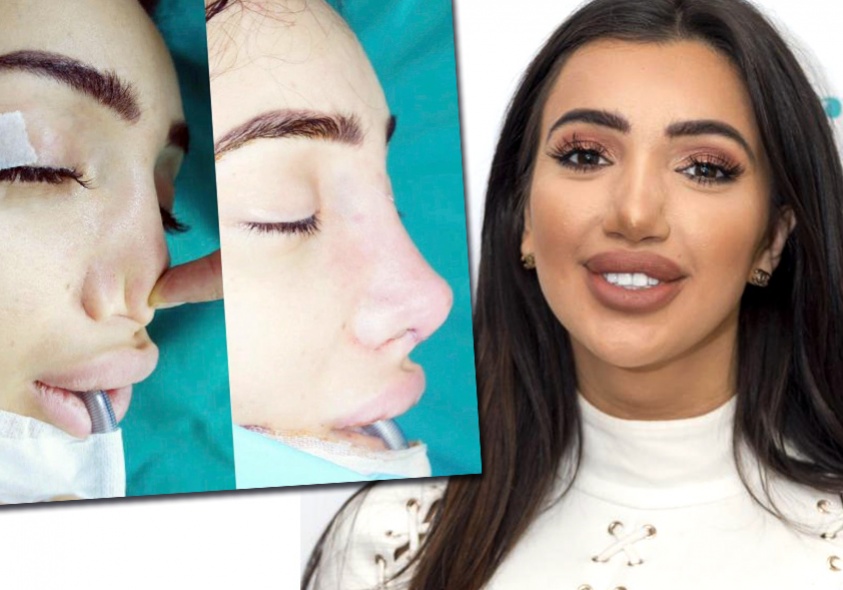 История британской модели: последствия неудачной ринопластики и важность выбора хирурга