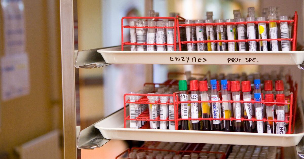 Epstein-Barr Virusni Aniqlash Uchun Mononukleoz Testi