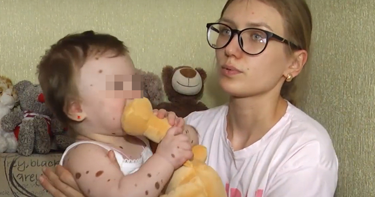 Perjalanan Inspiratif Gadis Kecil dengan Tahi Lalat Langka: Melangkah Bersama Harapan