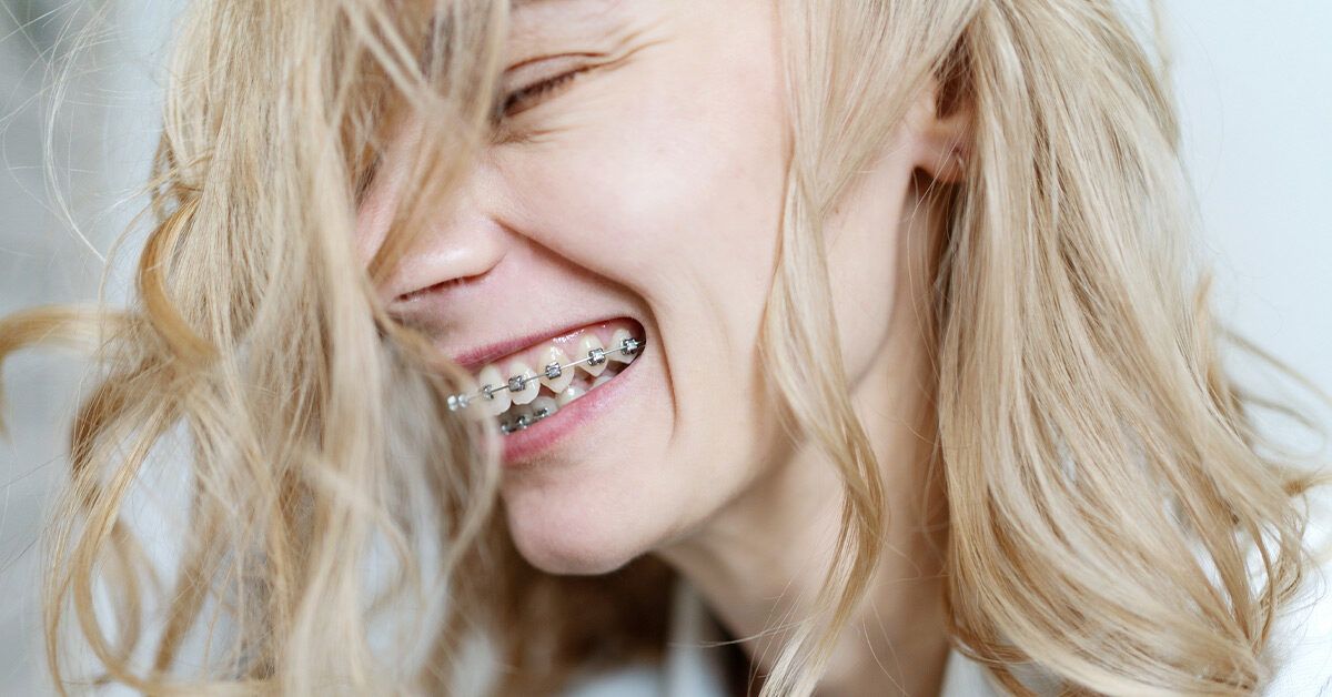 Self-Ligating Braces in 2025: Benefits, Costs, and How They Compare to Traditional Braces