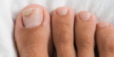 Nail on toes with separated nail bed